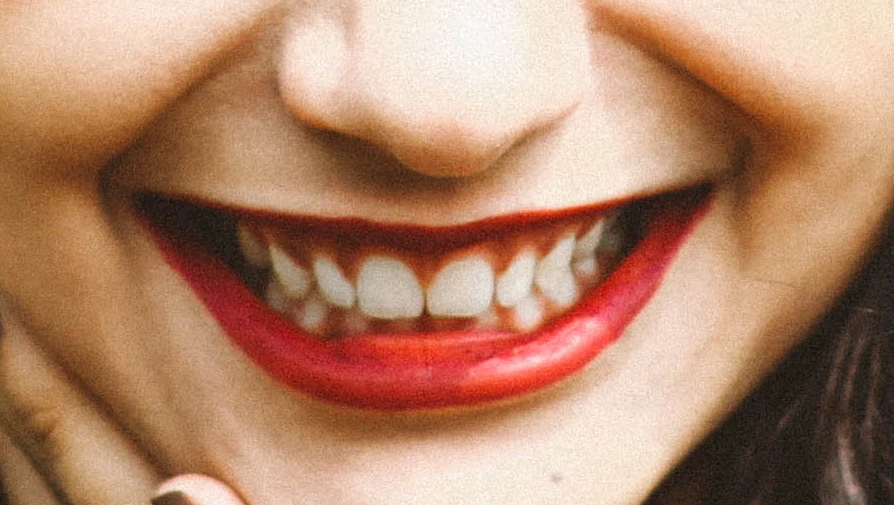 Teeth whitened, lips and gums untouched — after