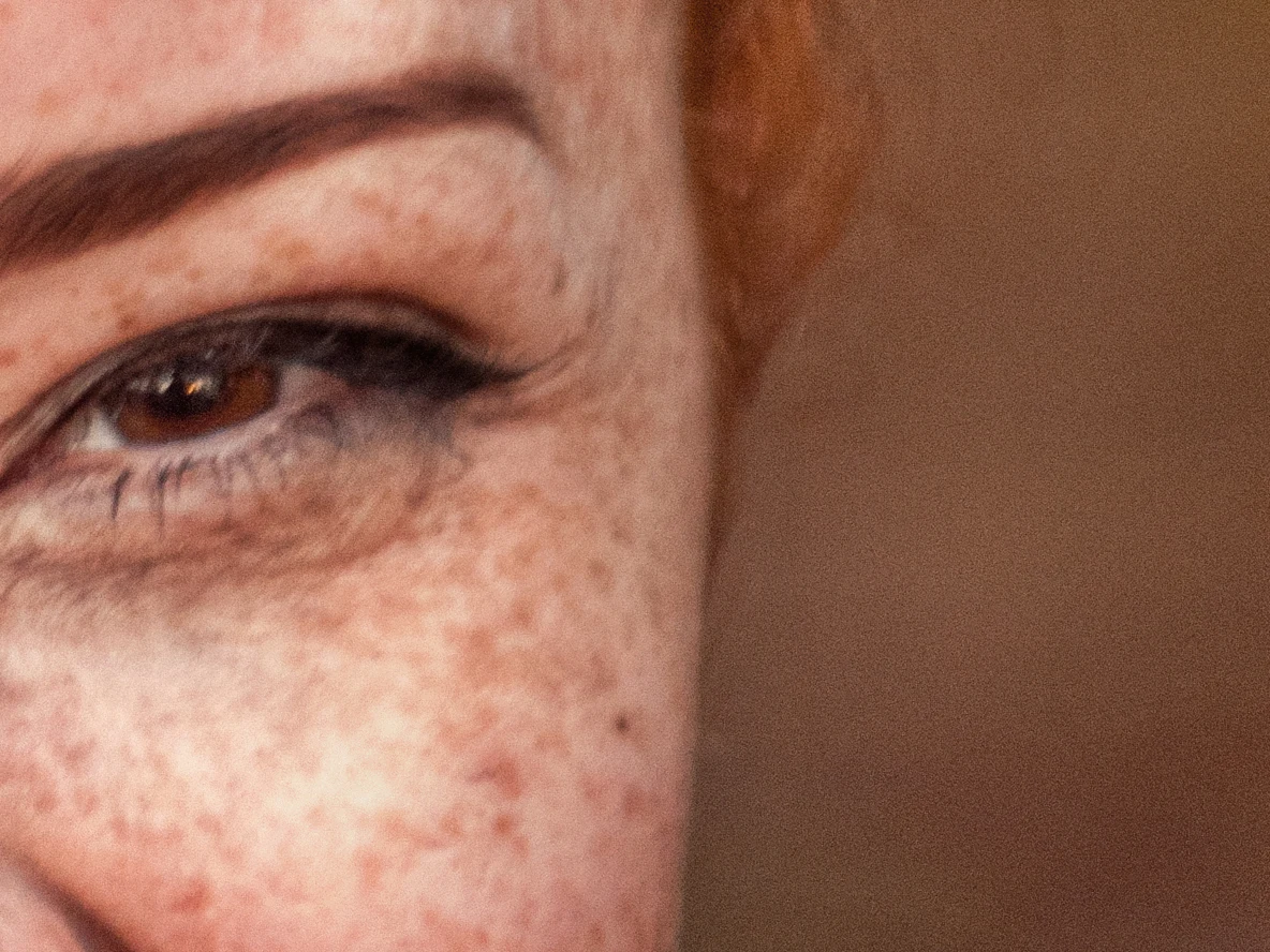 Crow's feet softened, freckles kept — before